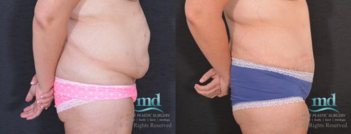 Before & After Liposuction Case 86 View #3 View in Melbourne, FL