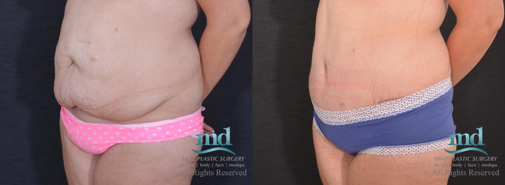 Before & After Liposuction Case 86 View #4 View in Melbourne, FL