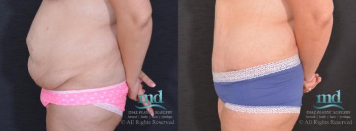 Before & After Liposuction Case 86 View #5 View in Melbourne, FL