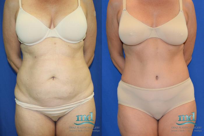 Before & After Liposuction Case 88 View #1 View in Melbourne, FL