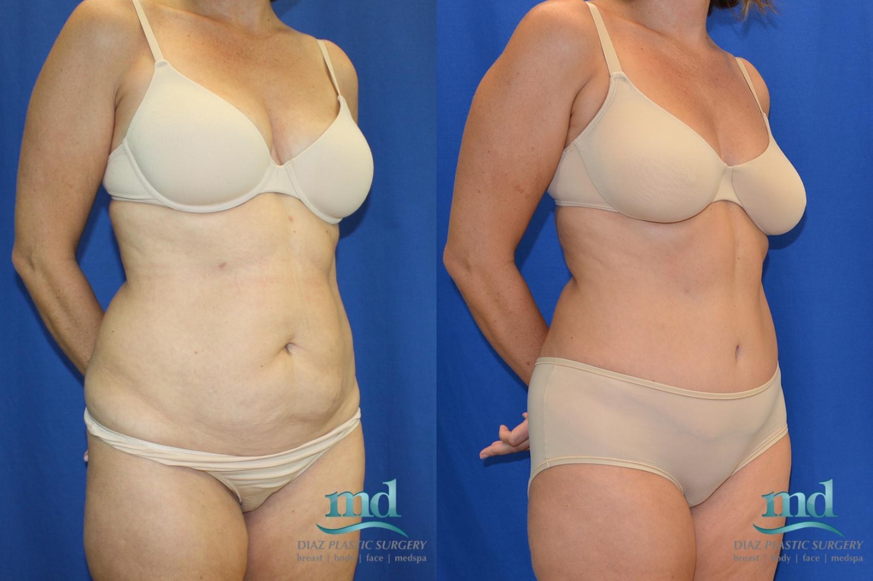 Before & After Liposuction Case 88 View #2 View in Melbourne, FL