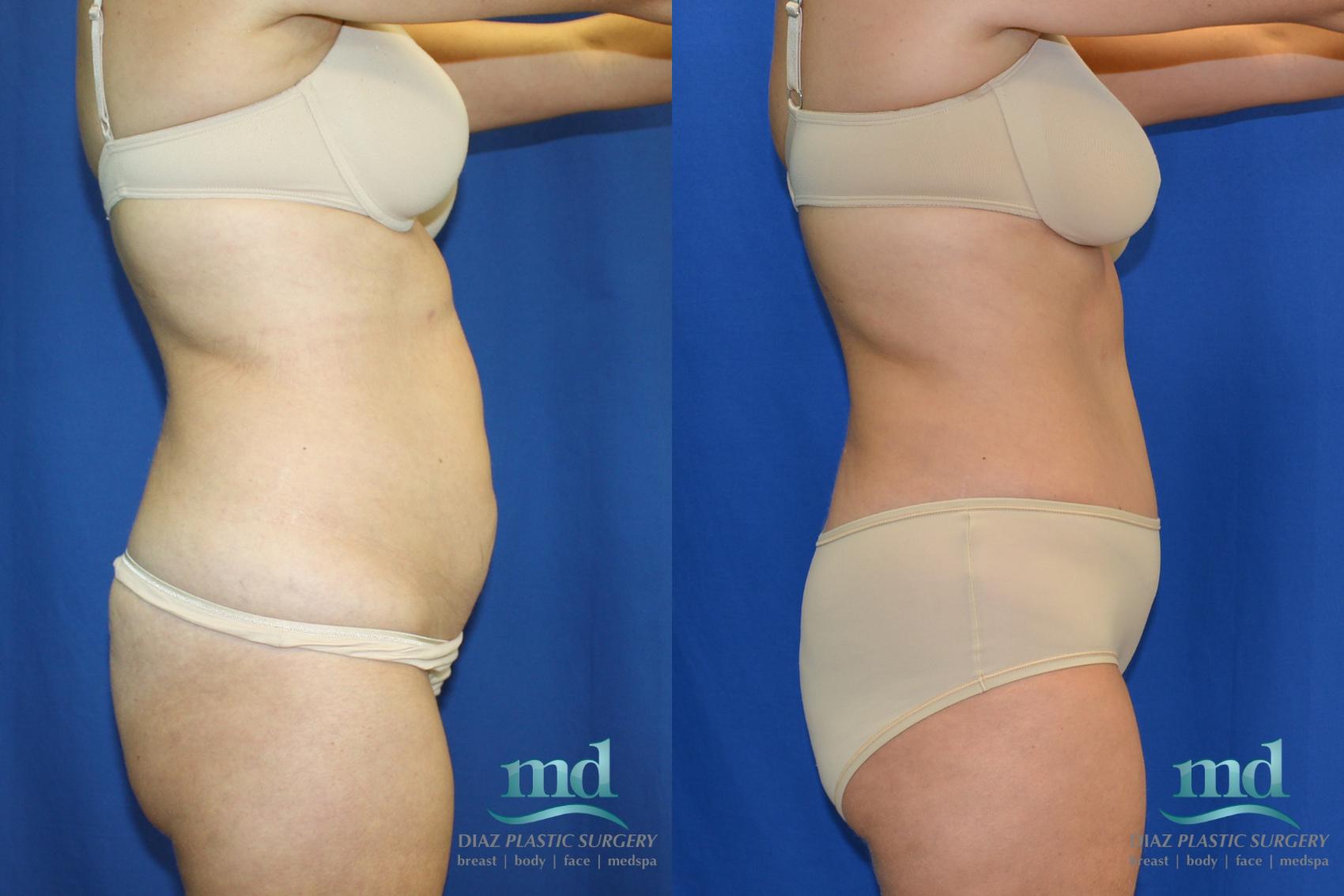 Before & After Liposuction Case 88 View #3 View in Melbourne, FL