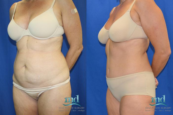 Before & After Liposuction Case 88 View #4 View in Melbourne, FL