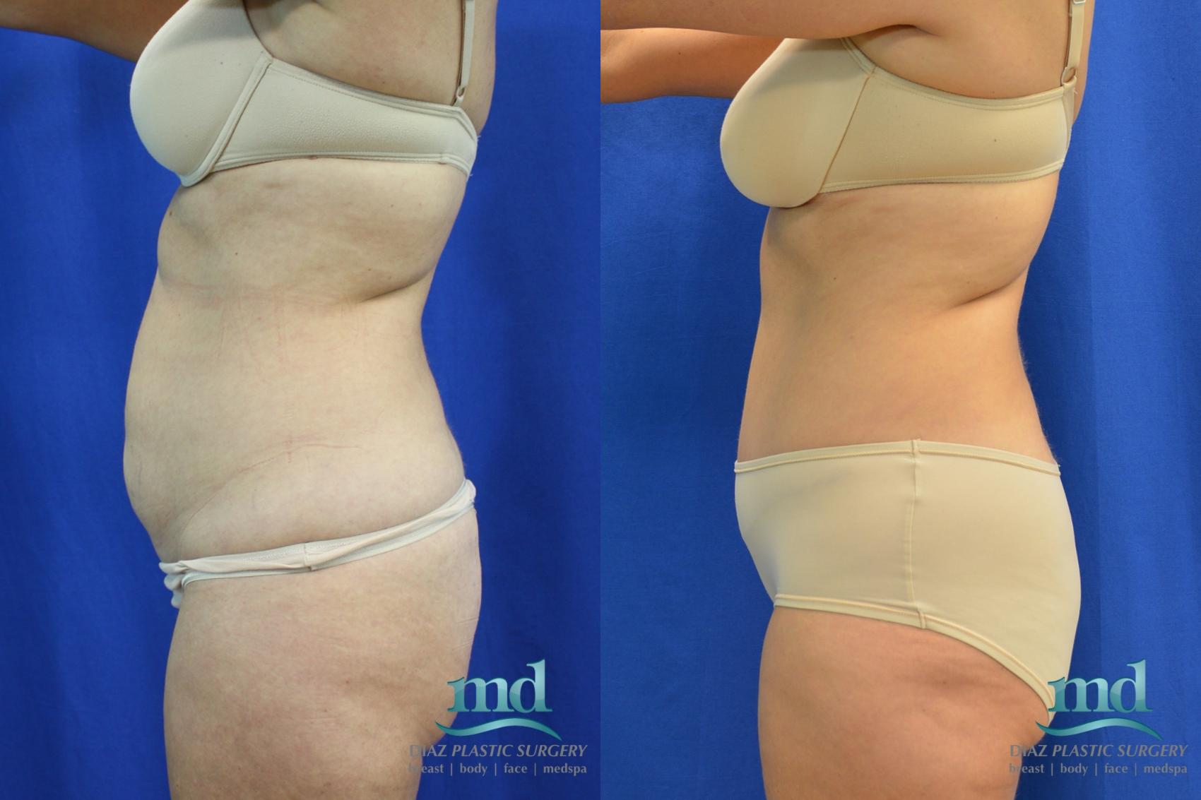 Before & After Liposuction Case 88 View #5 View in Melbourne, FL