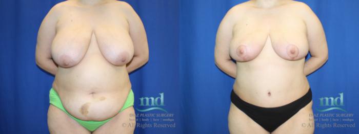 Before & After Liposuction Case 96 View #1 View in Melbourne, FL