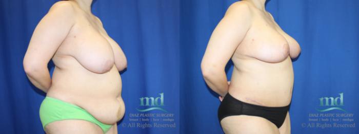 Before & After Liposuction Case 96 View #2 View in Melbourne, FL