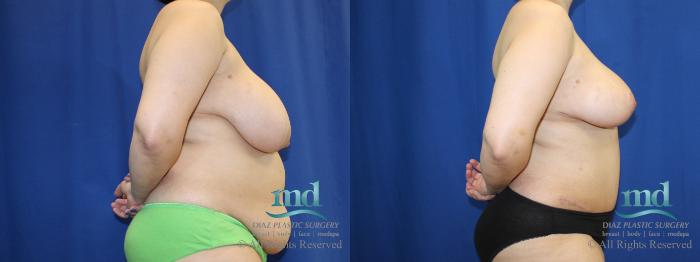 Before & After Liposuction Case 96 View #3 View in Melbourne, FL