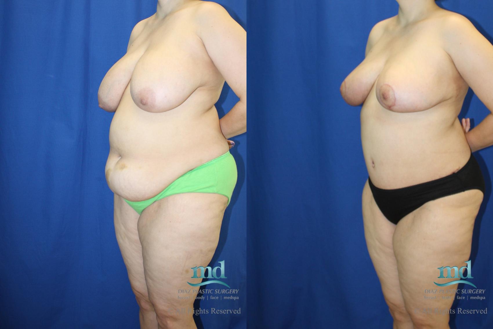 Before & After Liposuction Case 96 View #4 View in Melbourne, FL
