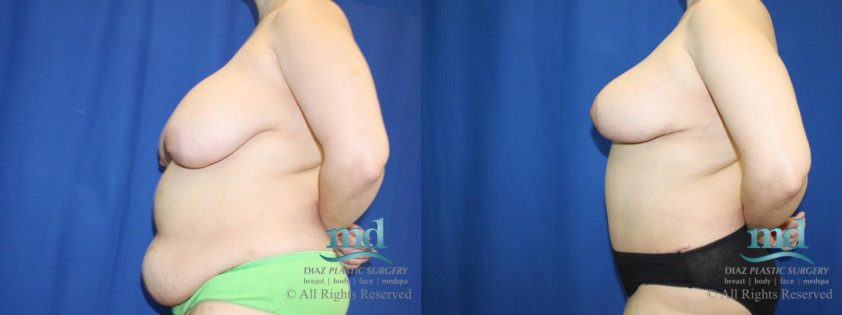 Before & After Liposuction Case 96 View #5 View in Melbourne, FL