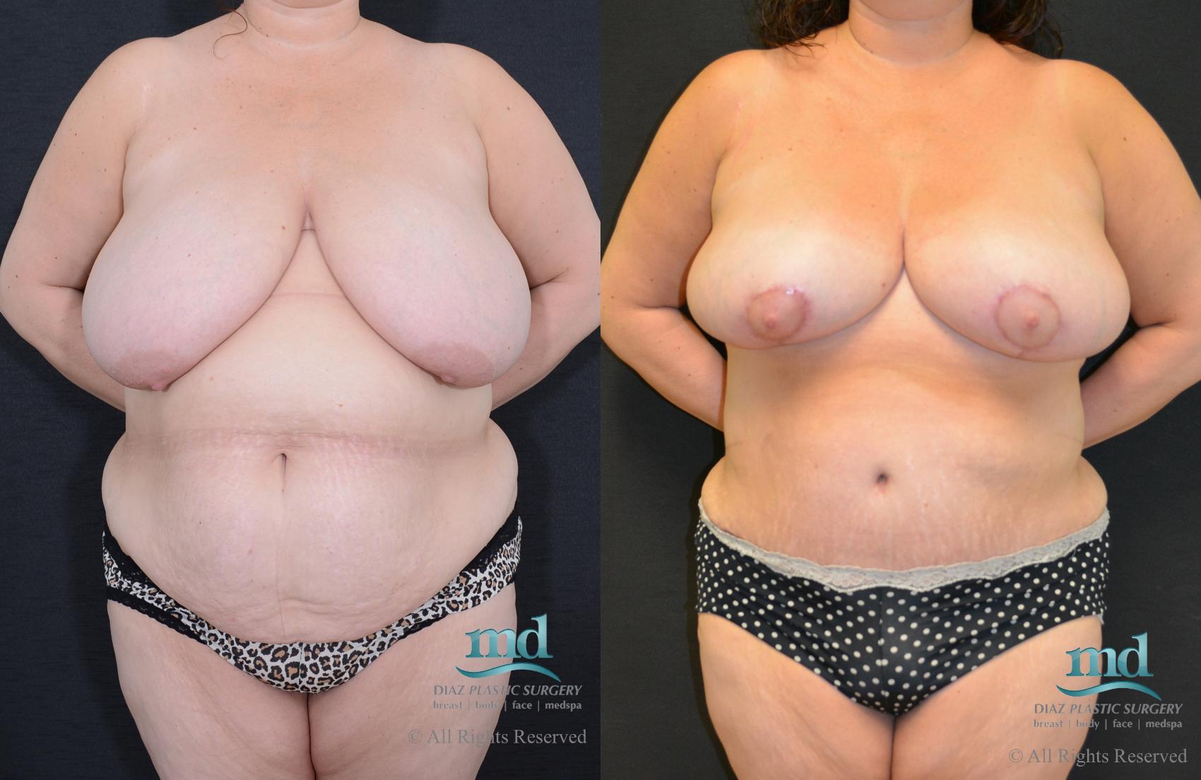 Before & After Liposuction Case 99 View #1 View in Melbourne, FL