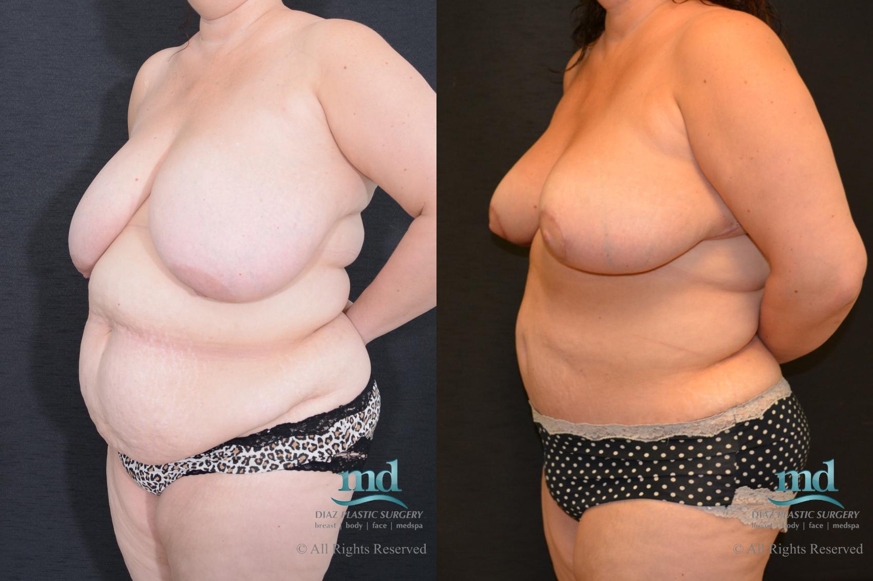 Before & After Liposuction Case 99 View #2 View in Melbourne, FL