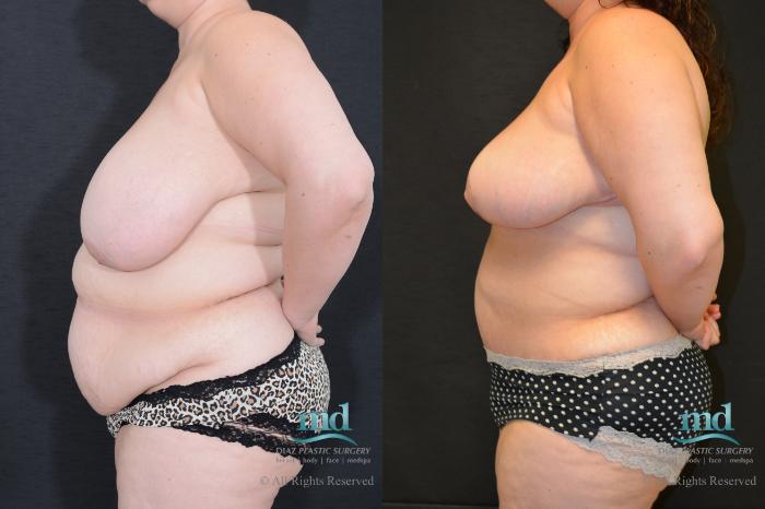 Before & After Liposuction Case 99 View #3 View in Melbourne, FL
