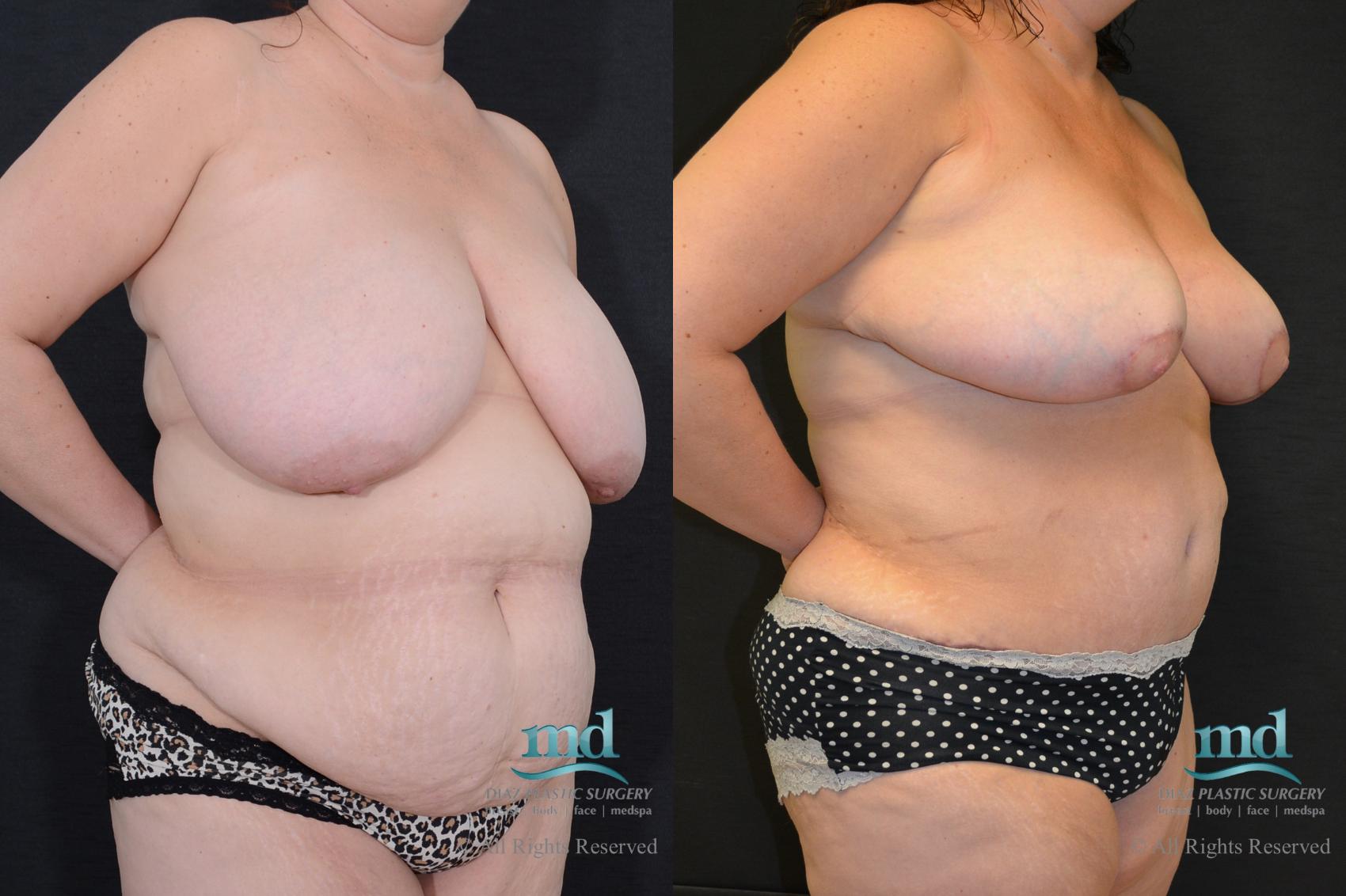 Before & After Liposuction Case 99 View #4 View in Melbourne, FL