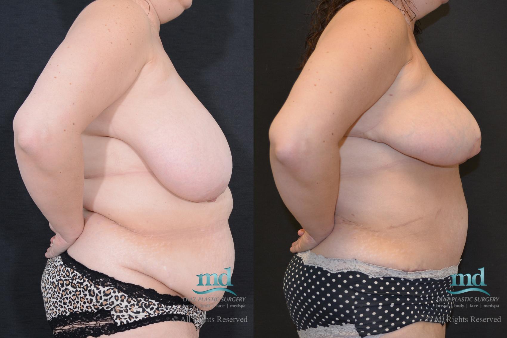 Before & After Liposuction Case 99 View #5 View in Melbourne, FL