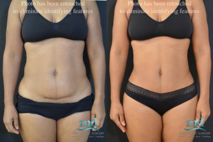 Mini Tuck And Tummy Tuck (abdominoplasty) Before & After Photos Patient 06