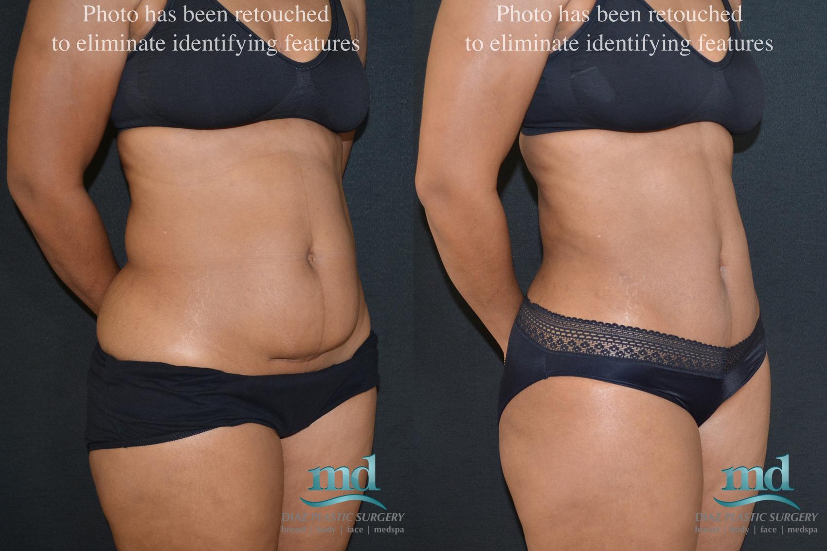 Before & After Mini Tummy Tuck Case 19 View #2 View in Melbourne, FL