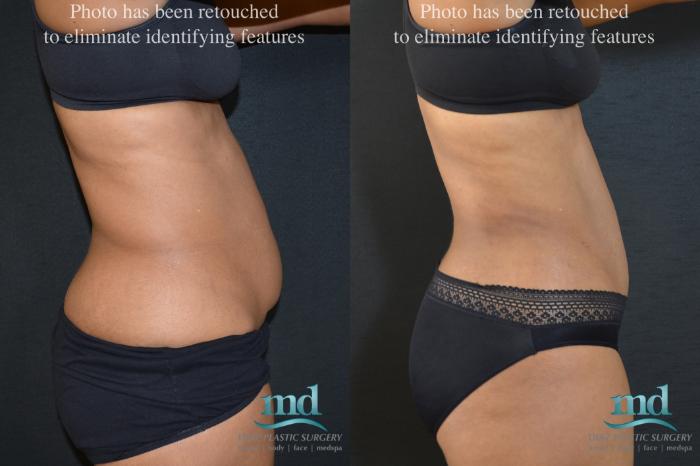 Before & After Mini Tummy Tuck Case 19 View #3 View in Melbourne, FL