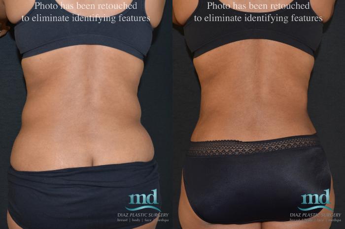 Before & After Mini Tummy Tuck Case 19 View #5 View in Melbourne, FL