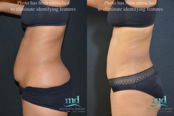Mini Tummy Tuck Before and After Photos Case 19, Melbourne, FL