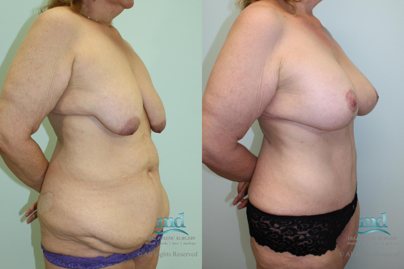Before & After Mommy Makeover Case 34 View #2 View in Melbourne, FL