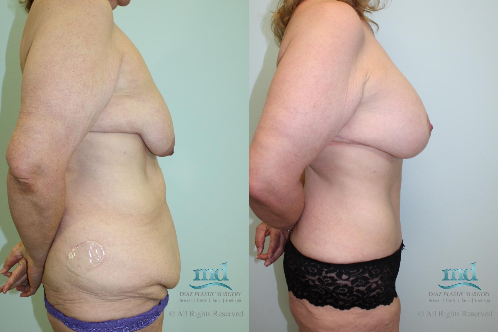 Before & After Mommy Makeover Case 34 View #3 View in Melbourne, FL