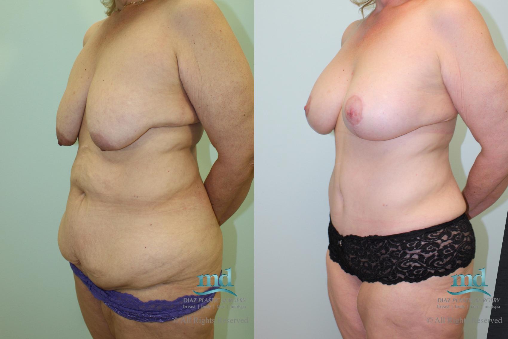 Before & After Mommy Makeover Case 34 View #4 View in Melbourne, FL