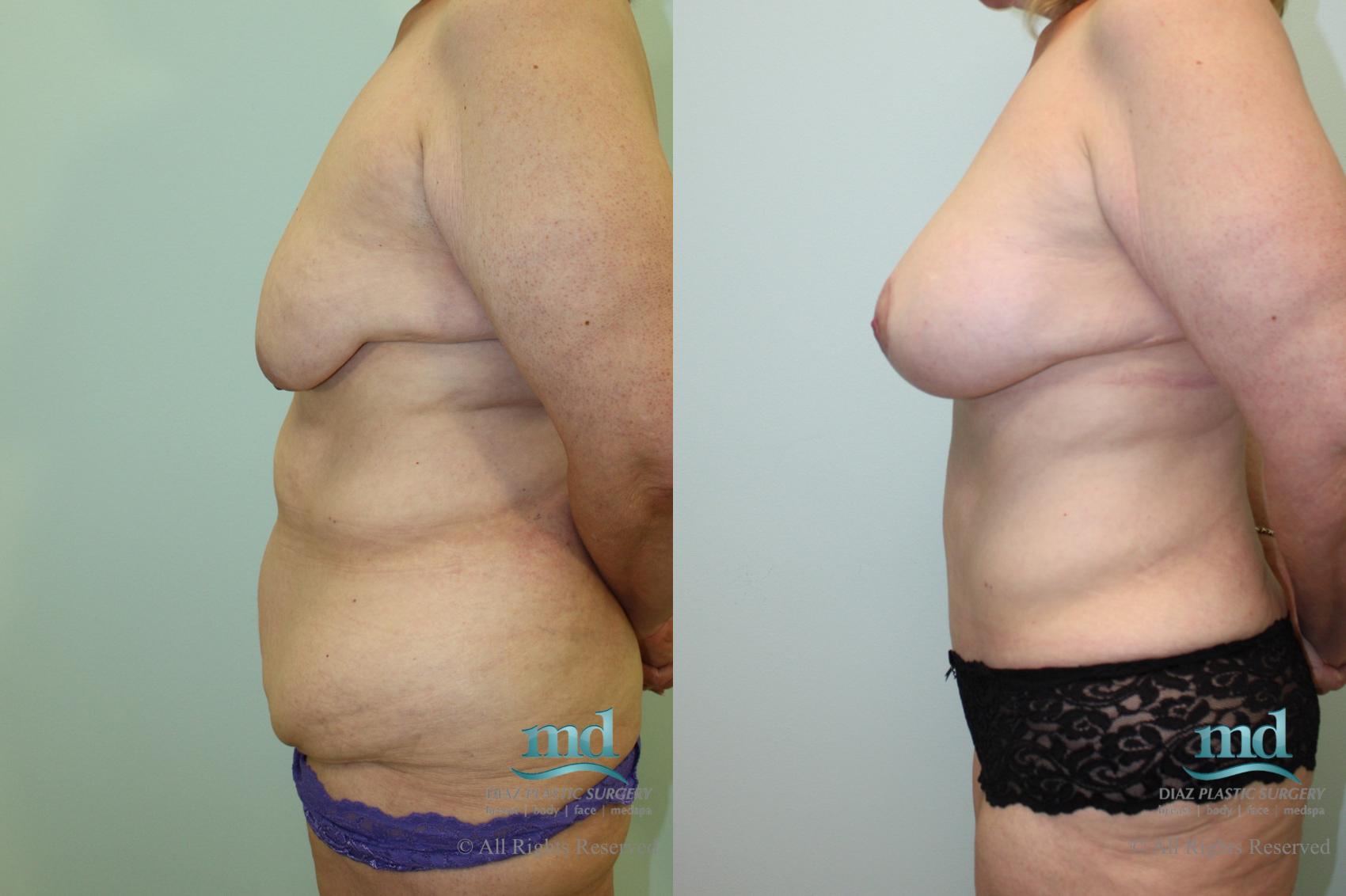 Before & After Mommy Makeover Case 34 View #5 View in Melbourne, FL