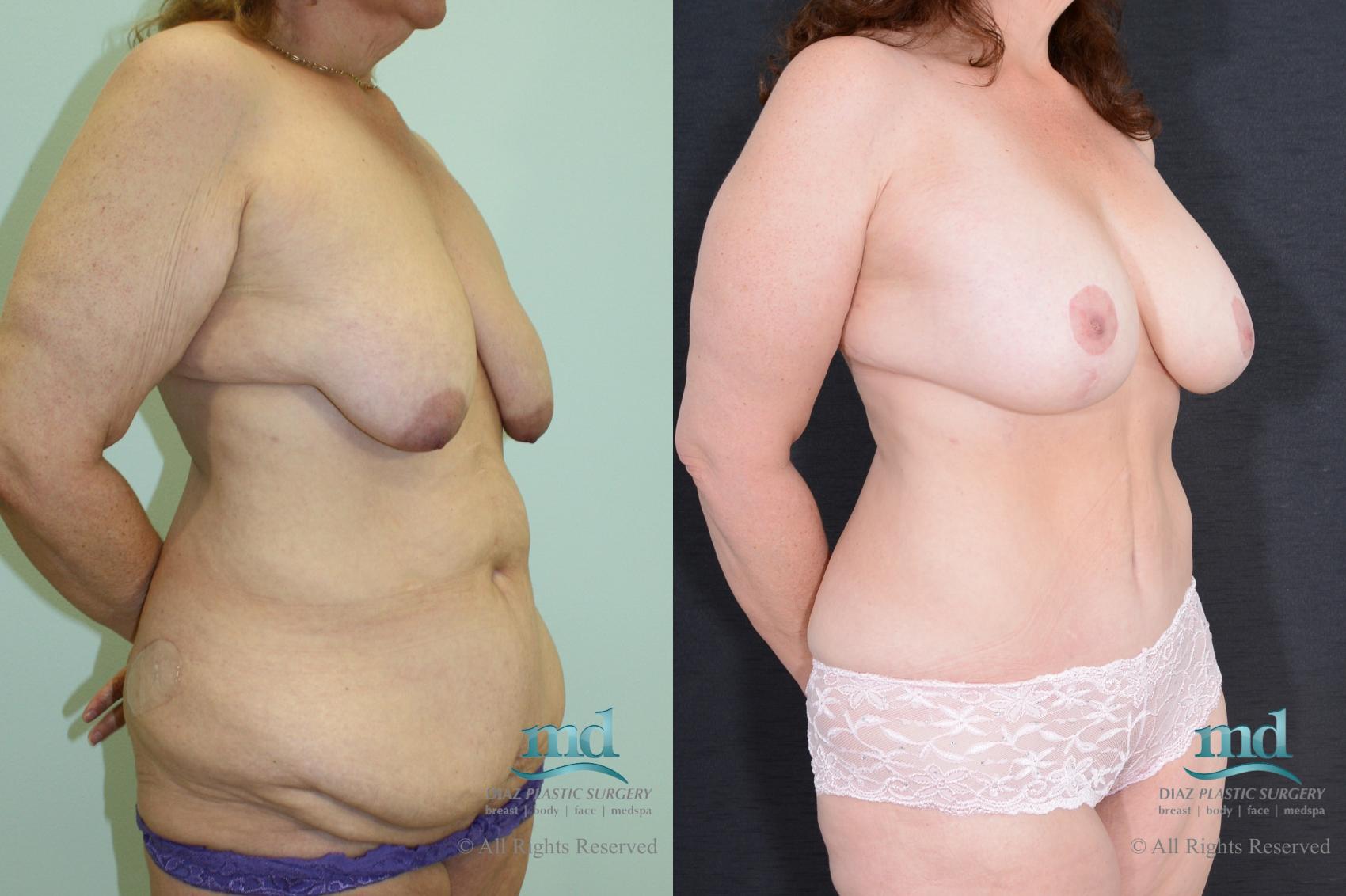 Before & After Mommy Makeover Case 35 View #2 View in Melbourne, FL