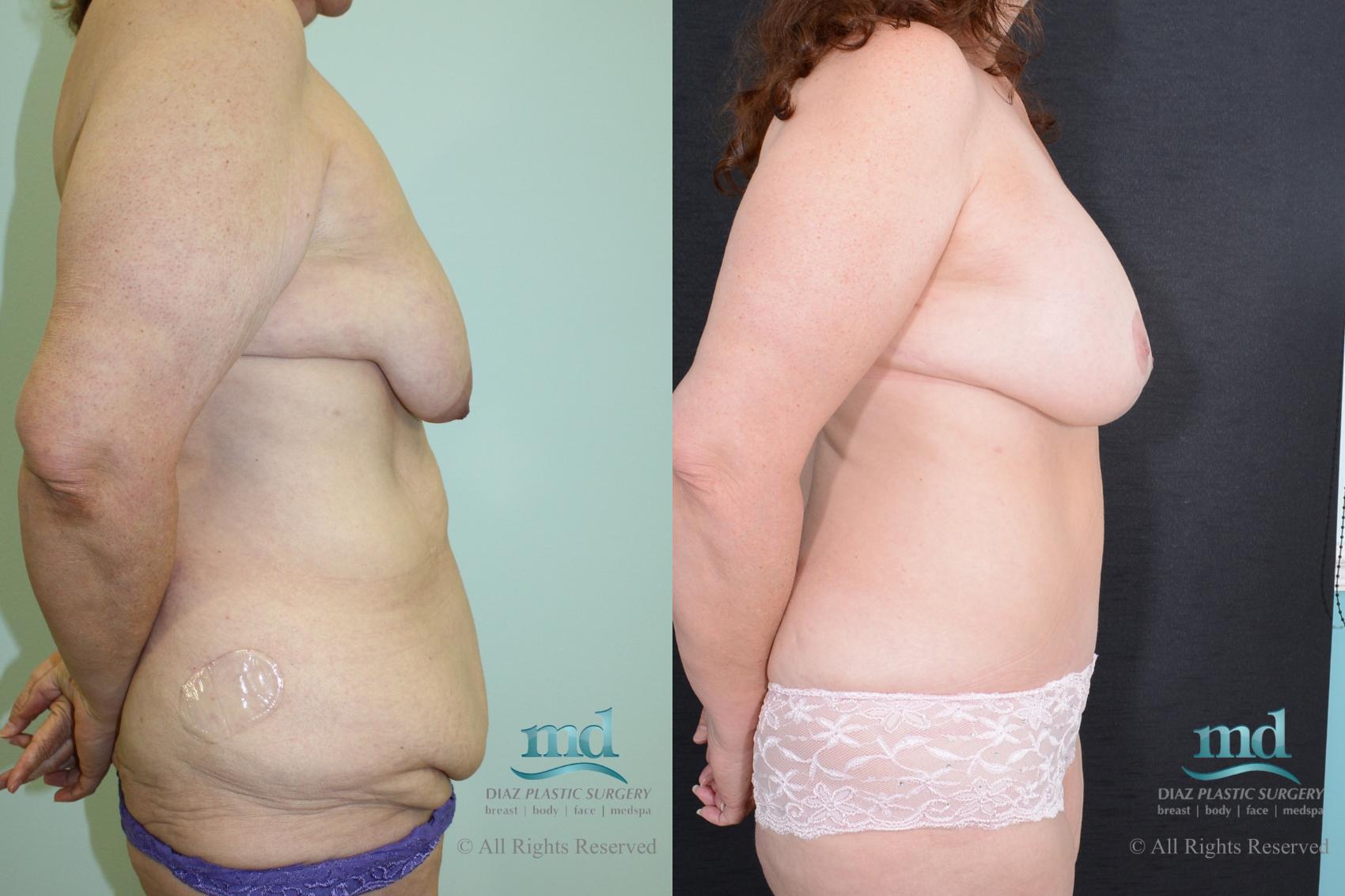 Before & After Mommy Makeover Case 35 View #3 View in Melbourne, FL