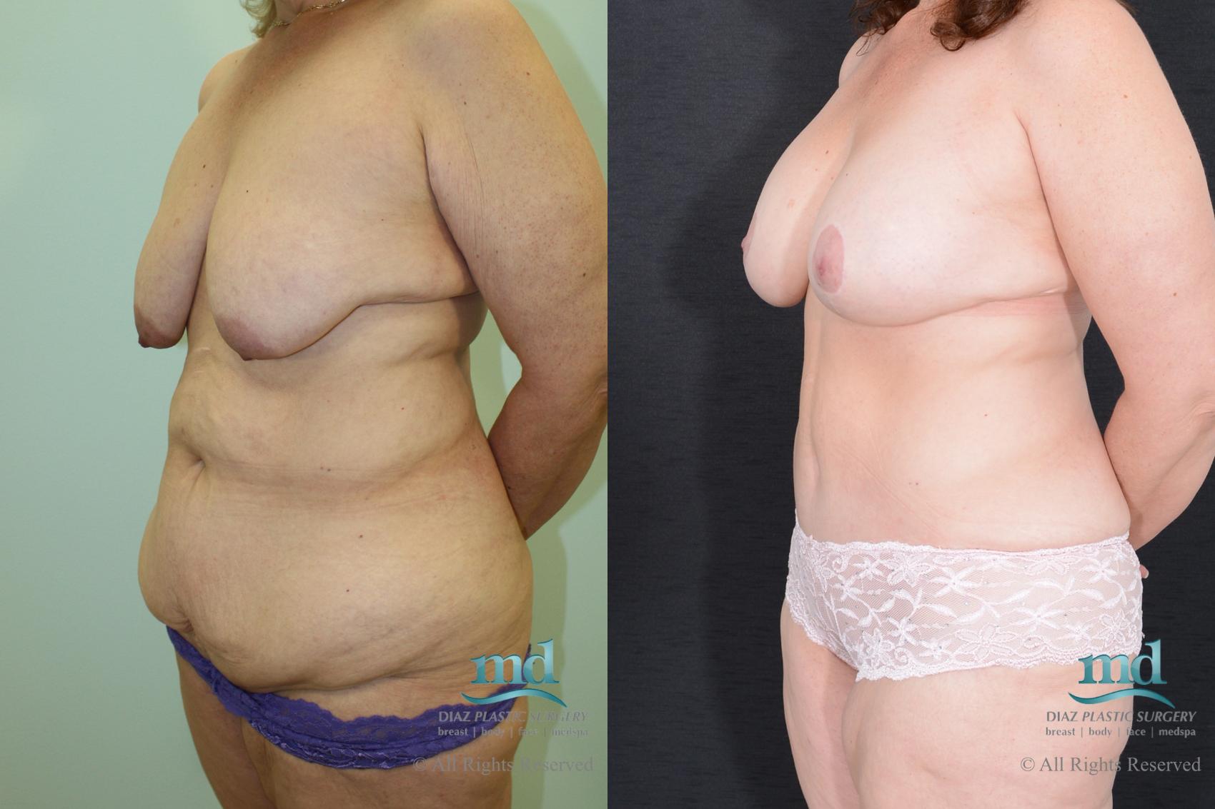 Before & After Mommy Makeover Case 35 View #4 View in Melbourne, FL