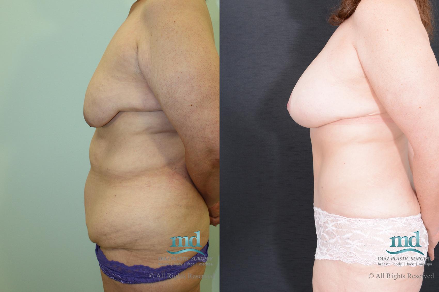 Before & After Mommy Makeover Case 35 View #5 View in Melbourne, FL