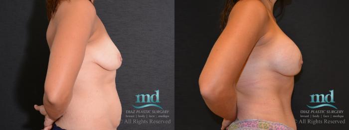 Before & After Mommy Makeover Case 94 View #3 View in Melbourne, FL