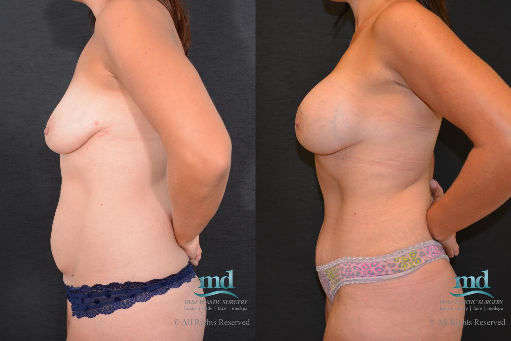 Before & After Mommy Makeover Case 94 View #5 View in Melbourne, FL