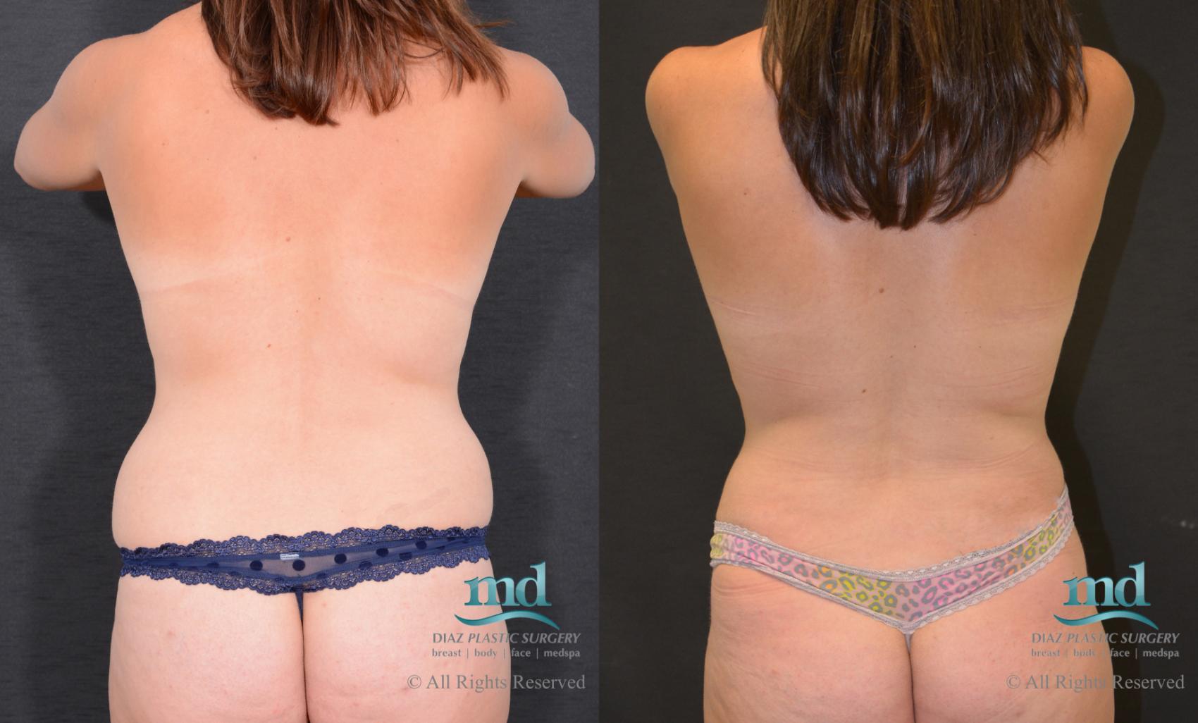 Before & After Mommy Makeover Case 94 View #6 View in Melbourne, FL