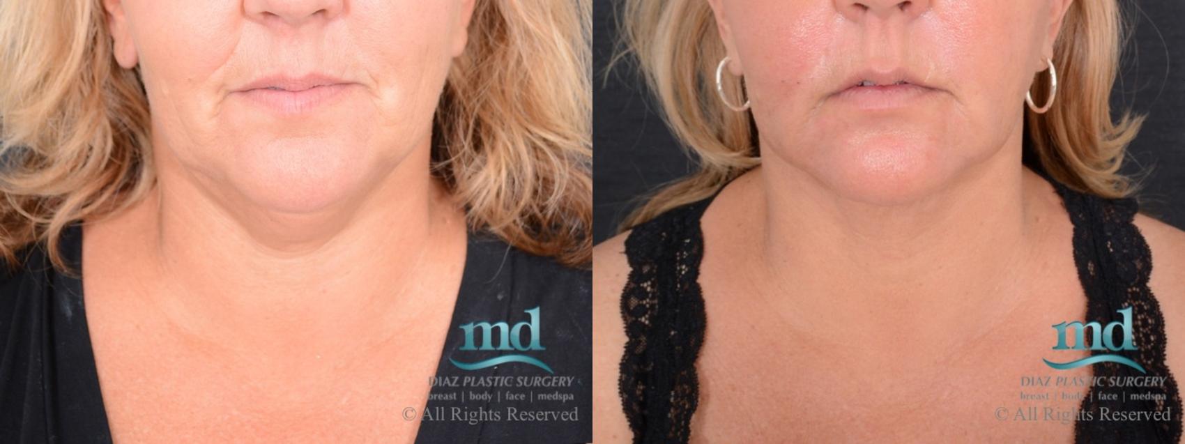Before & After Neck Lift Case 115 View #1 View in Melbourne, FL