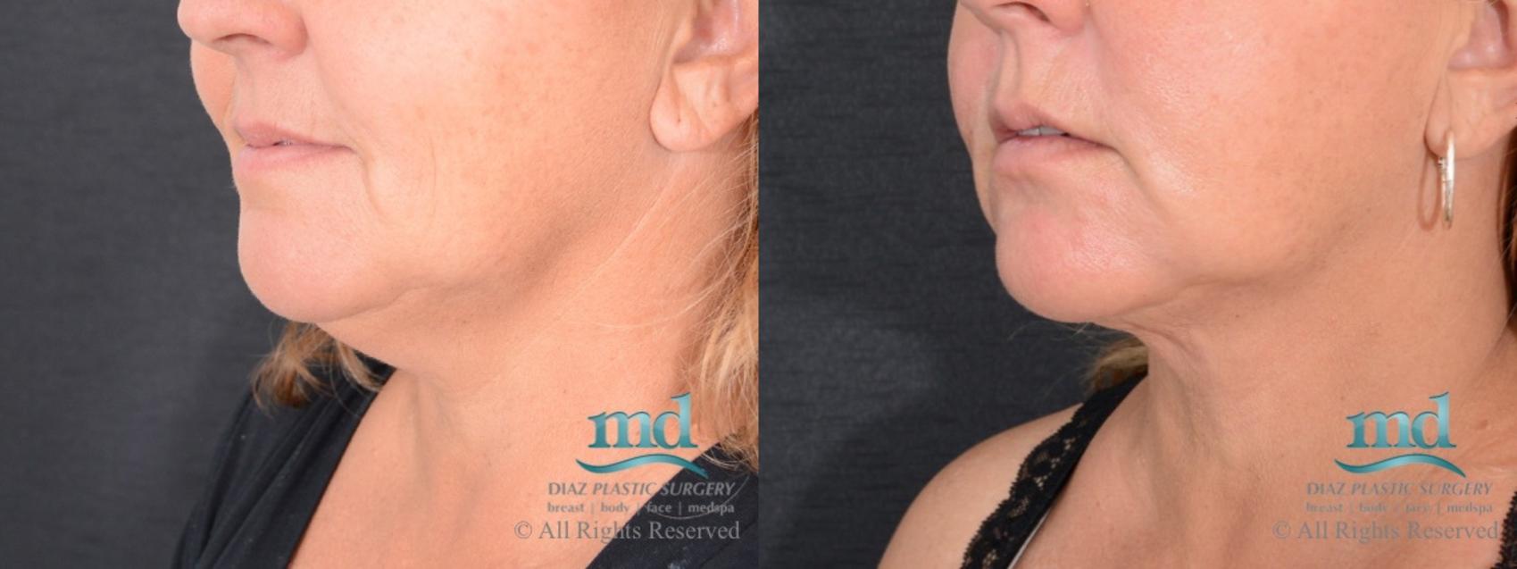 Before & After Neck Lift Case 115 View #2 View in Melbourne, FL
