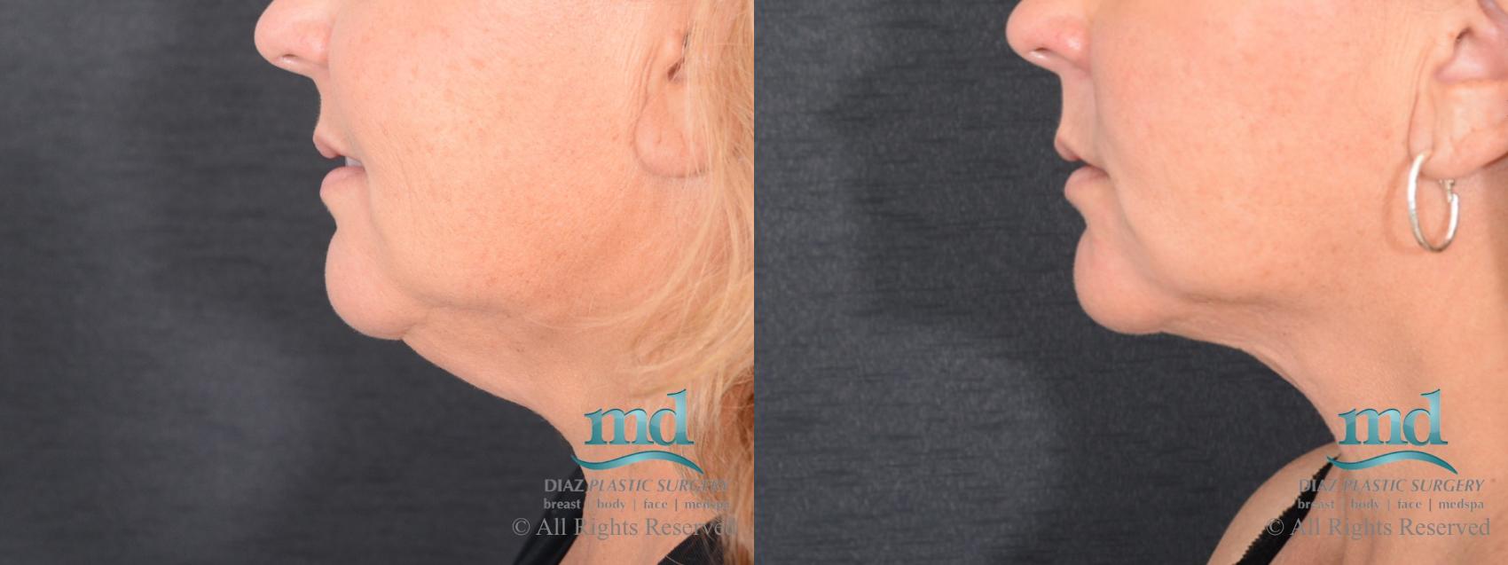 Before & After Neck Lift Case 115 View #3 View in Melbourne, FL