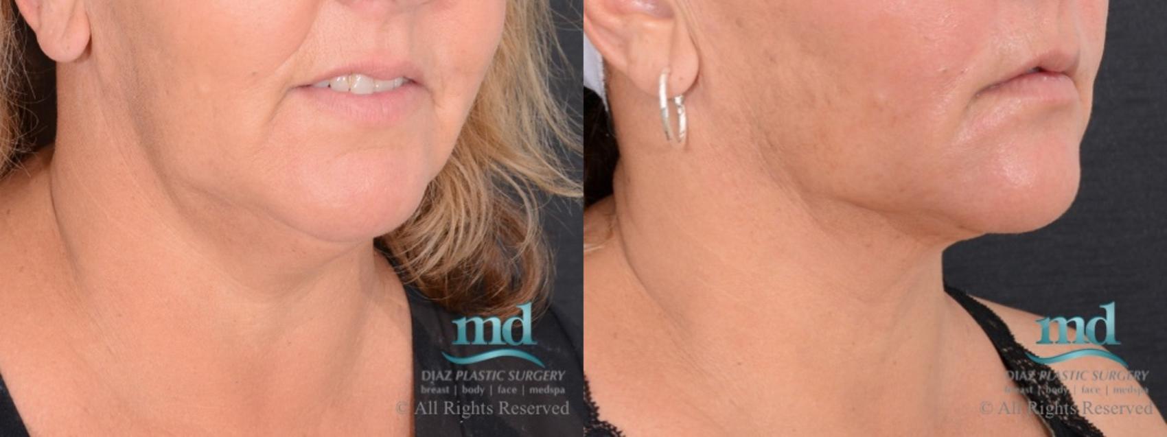 Before & After Neck Lift Case 115 View #4 View in Melbourne, FL