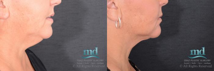 Before & After Neck Lift Case 115 View #5 View in Melbourne, FL
