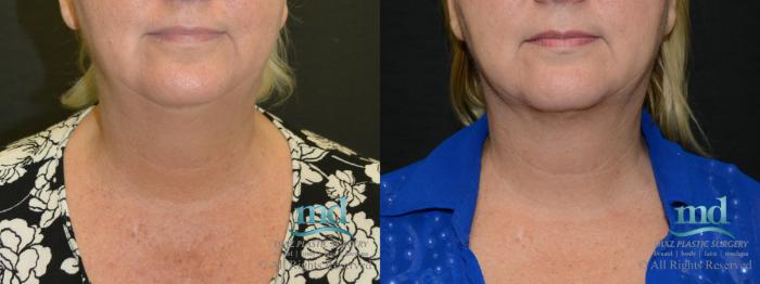 Before & After Neck Lift Case 116 View #1 View in Melbourne, FL