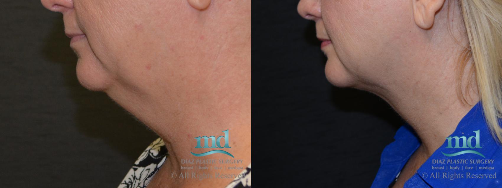 Before & After Neck Lift Case 116 View #2 View in Melbourne, Viera, Brevard County, FL