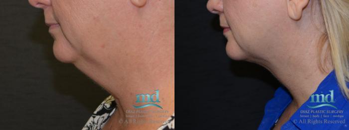 Before & After Neck Lift Case 116 View #2 View in Melbourne, FL