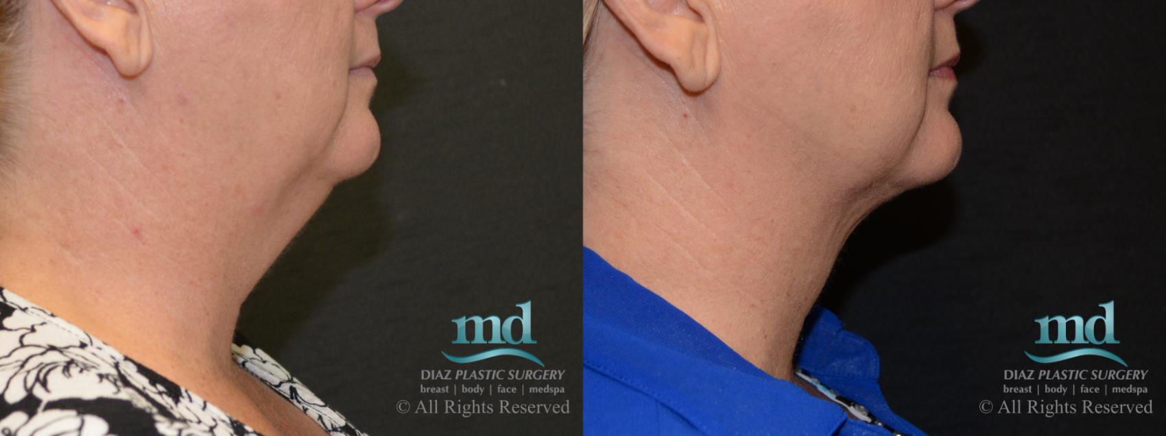 Before & After Neck Lift Case 116 View #3 View in Melbourne, FL