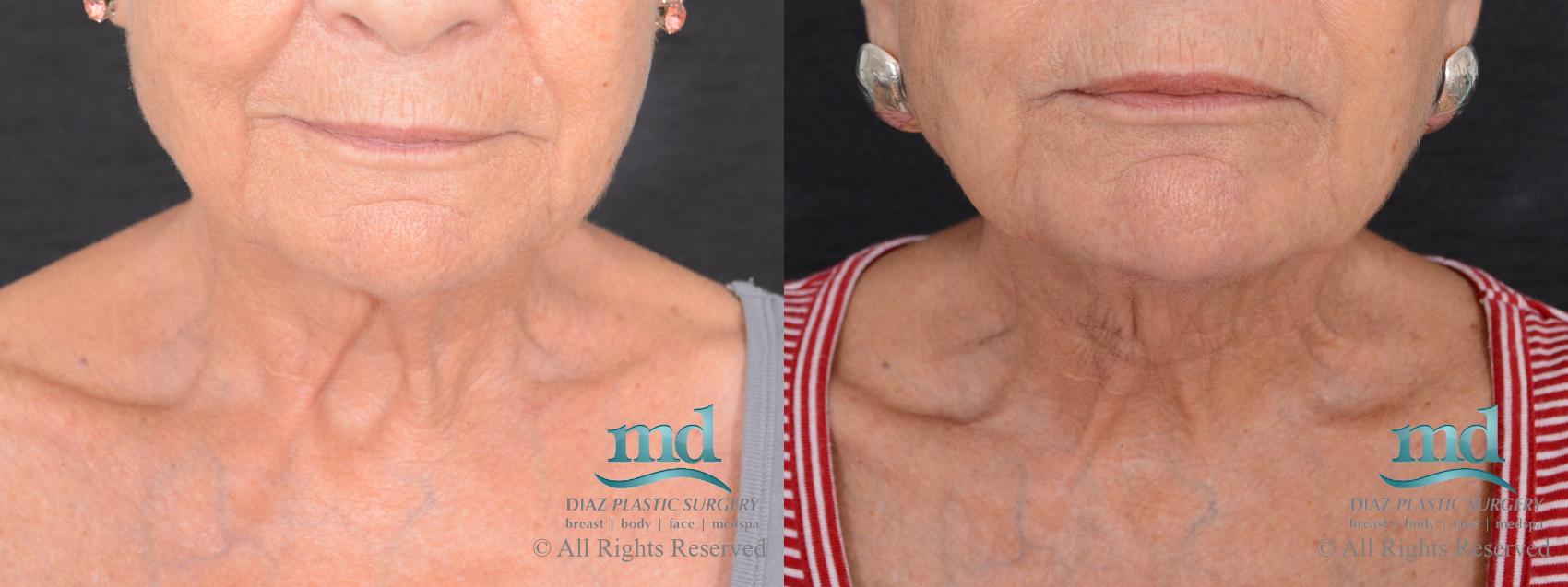 Before & After Neck Lift Case 125 View #1 View in Melbourne, FL