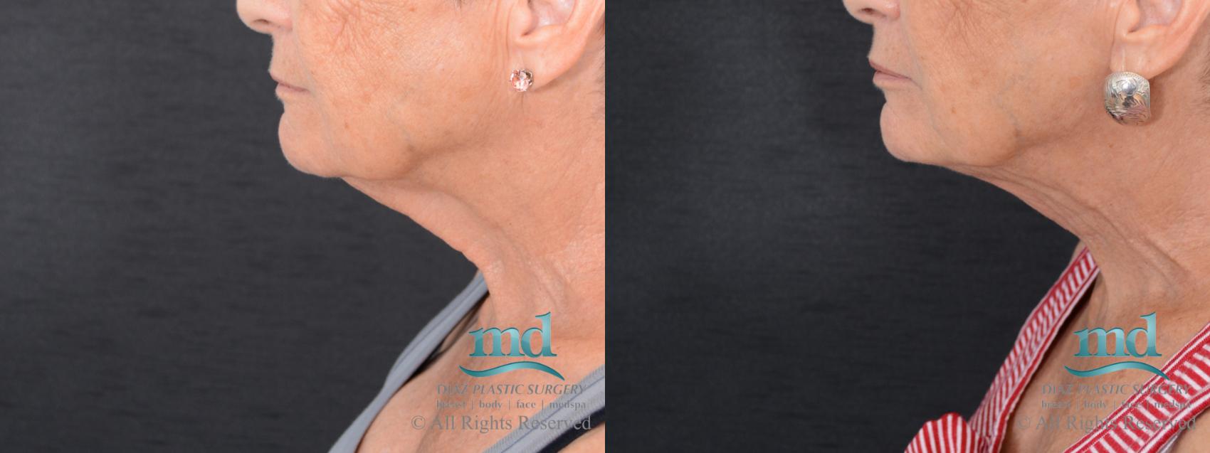 Before & After Neck Lift Case 125 View #2 View in Melbourne, FL