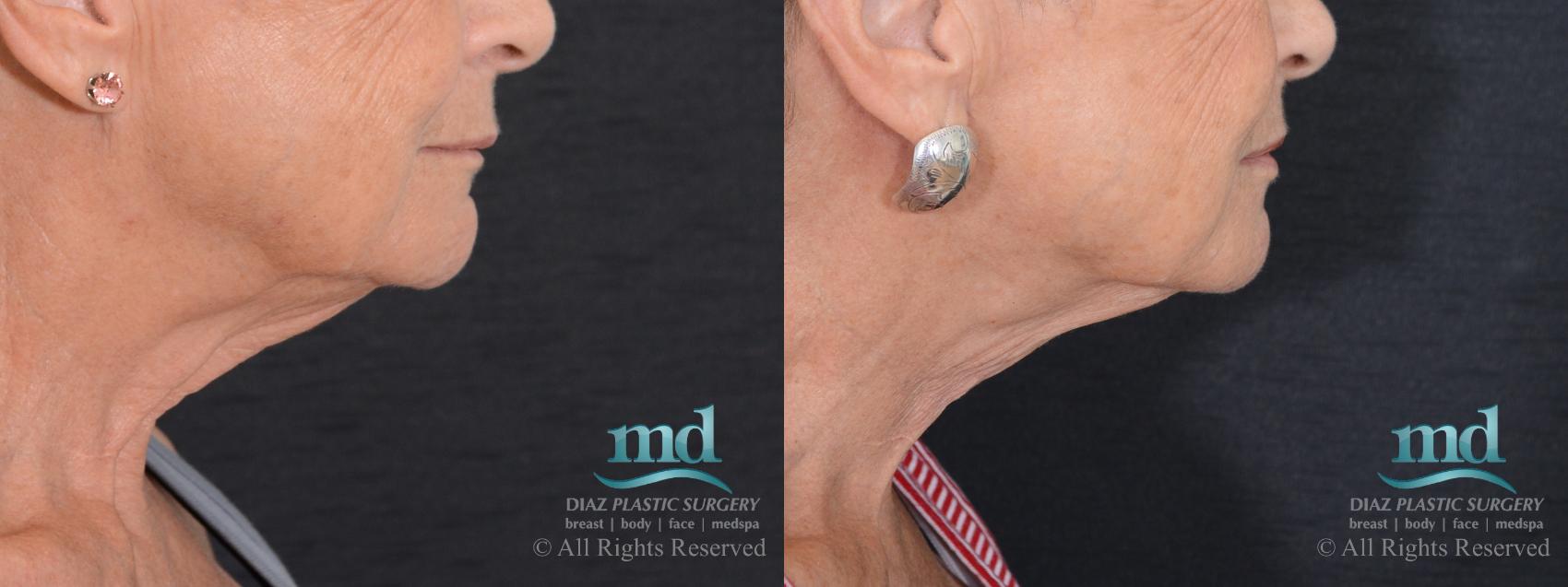 Before & After Neck Lift Case 125 View #3 View in Melbourne, FL