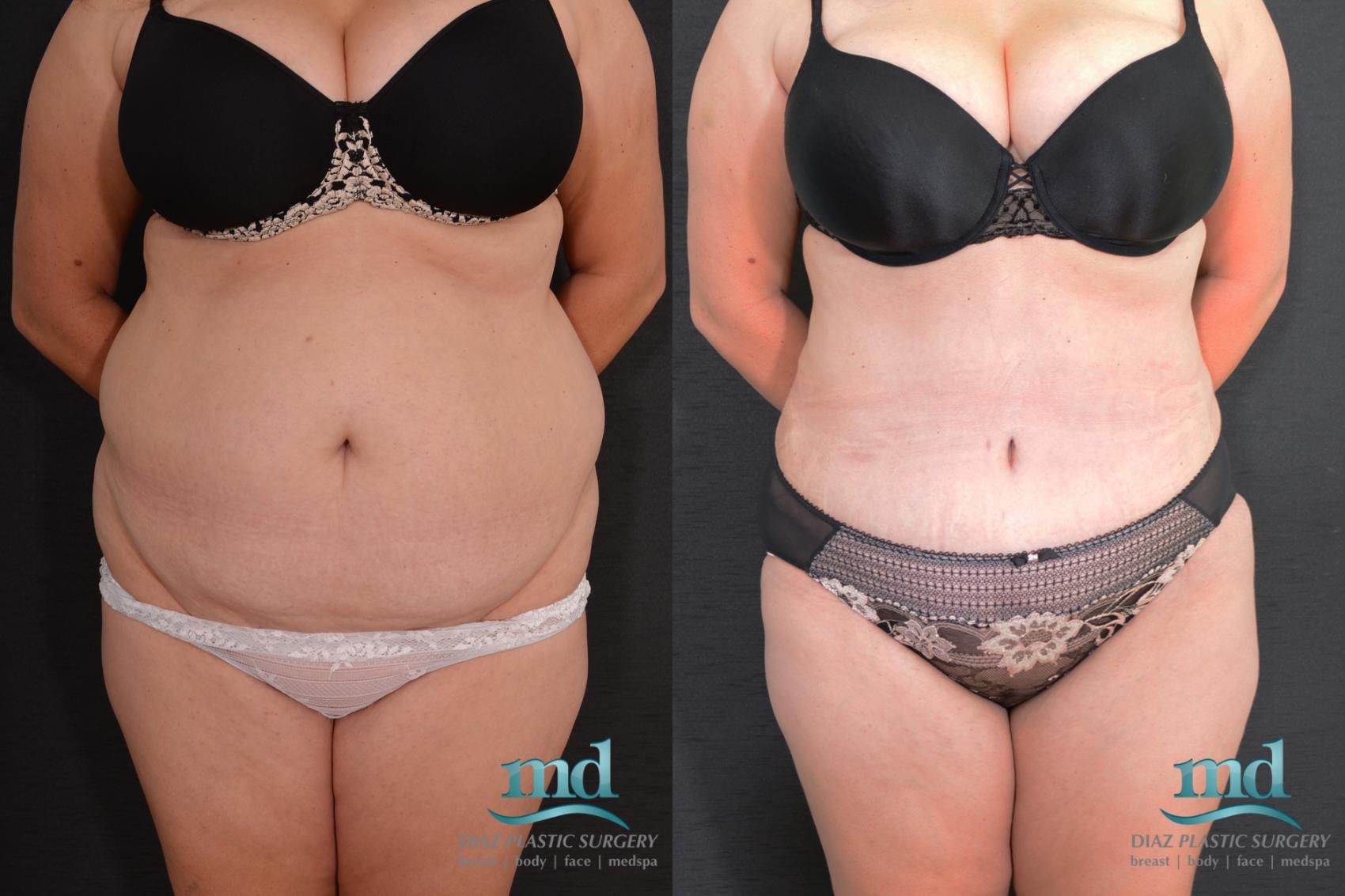 Before & After SAFE-Lipo® Case 8 View #1 View in Melbourne, FL
