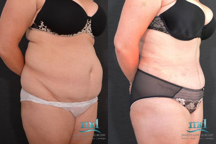 Before & After SAFE-Lipo® Case 8 View #2 View in Melbourne, FL