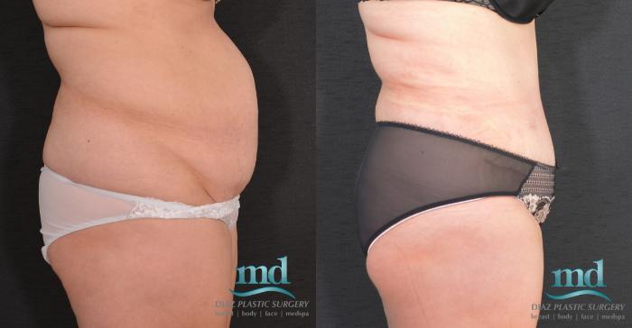 Before & After SAFE-Lipo® Case 8 View #3 View in Melbourne, FL