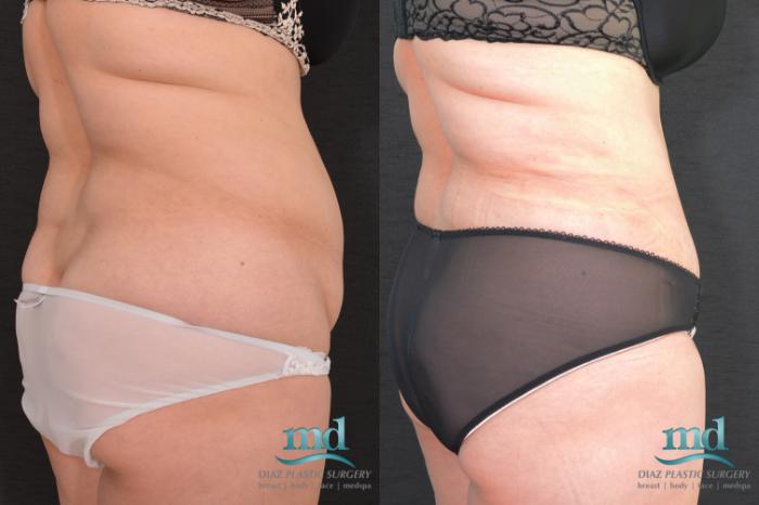 Before & After SAFE-Lipo® Case 8 View #4 View in Melbourne, FL